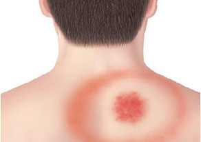 Classic Lyme disease rash