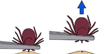 Illustration showing how to remove a tick